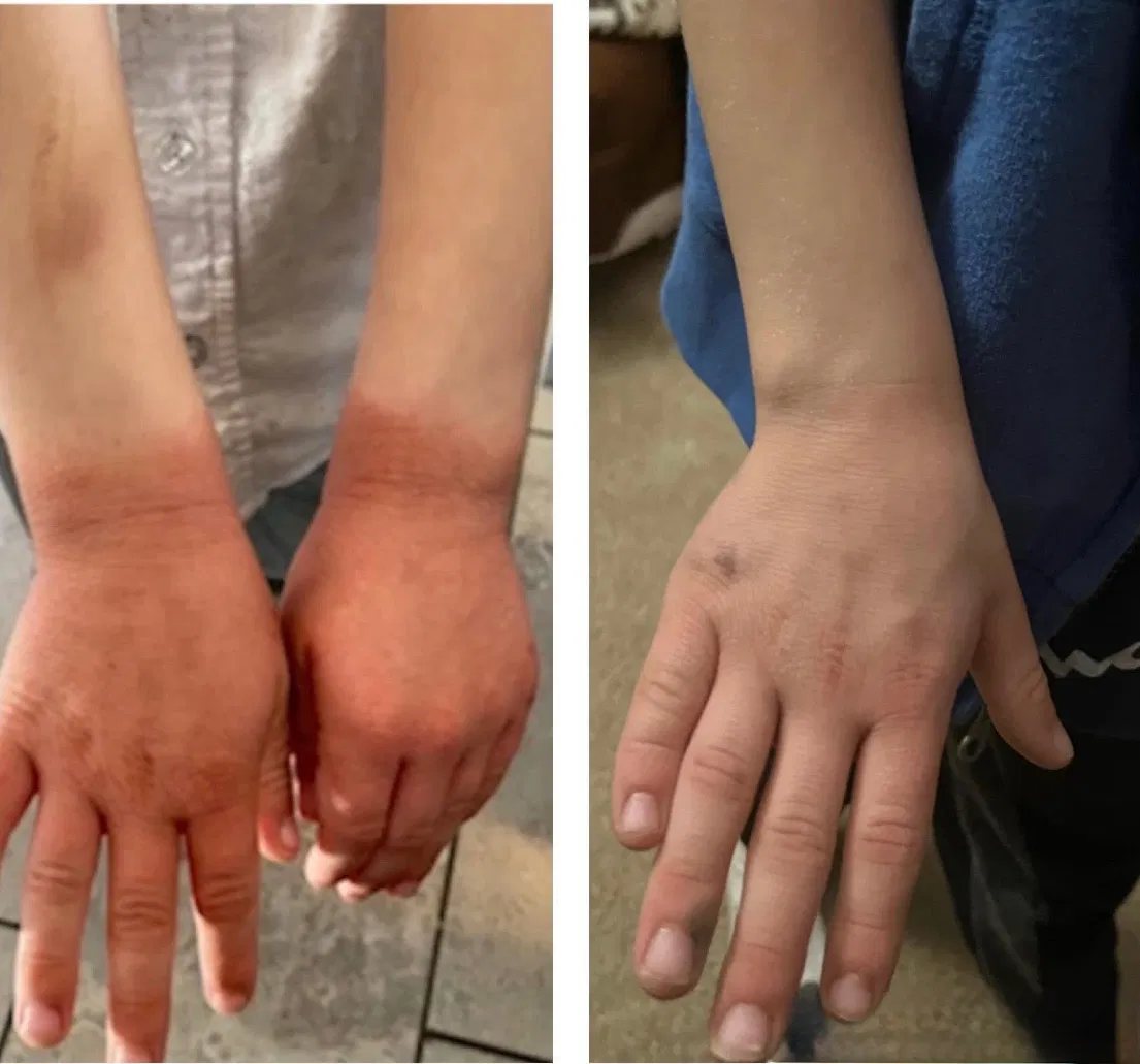 A child's hands and forearms photographed side by side: on the left, red and inflamed skin across both hands and wrists; on the right, the same hands with clear, calm skin.